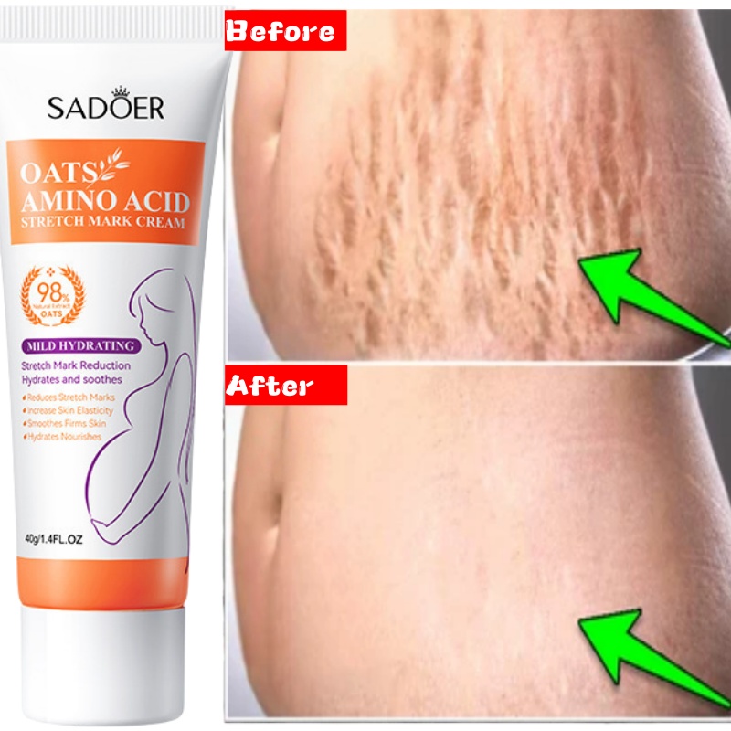 Skincare Oat - Striae Permanente Verwijderingscrème Elimineren Lichaam Buik