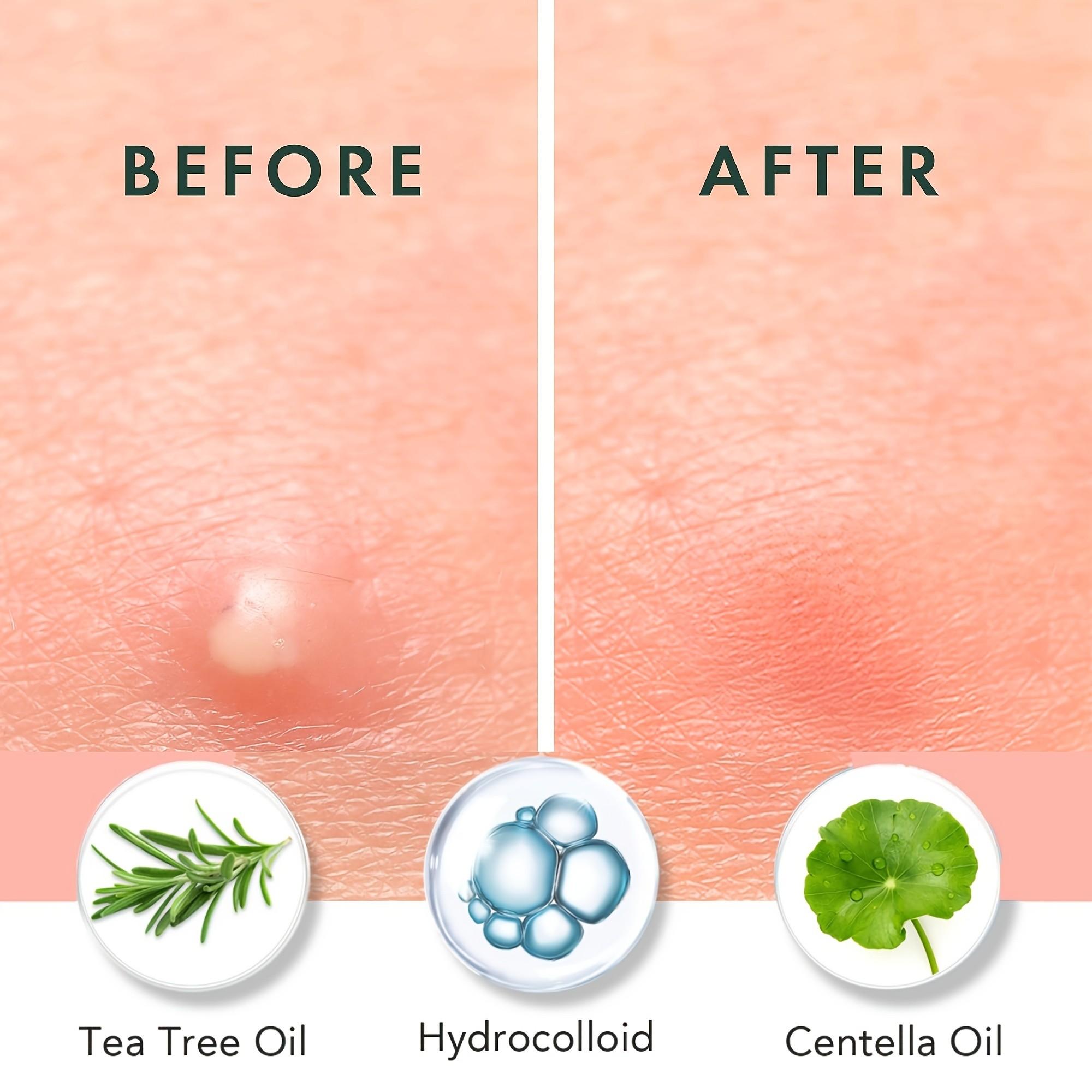 180/360/720 stuks acnepleister - Skincare Oil Control recensie en prijs
