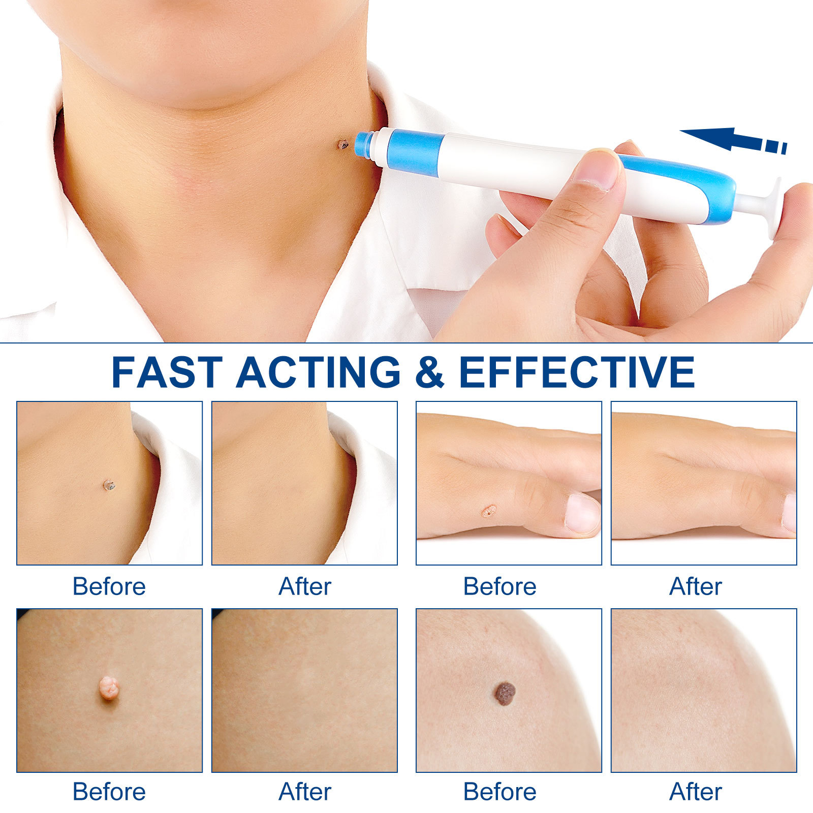2-IN-1 Auto Skin Tag Removal K - Skincare Ingredients Checker recensie en prijs